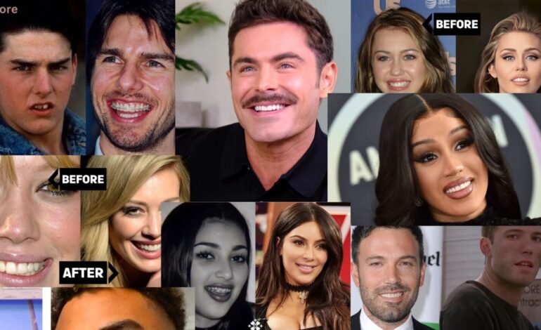 Celebrities With Veneers