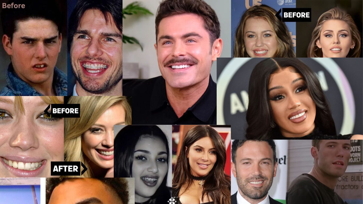 Celebrities With Veneers: The Hollywood Secret to Perfect Smiles